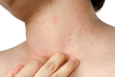alergia a parásitos subcutáneos