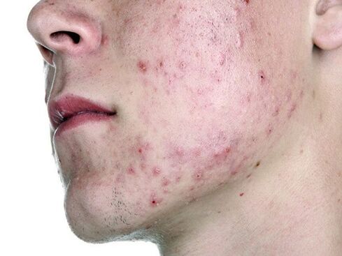 parásito subcutáneo demodex en la cara