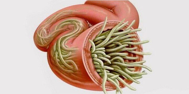 gusanos en los intestinos