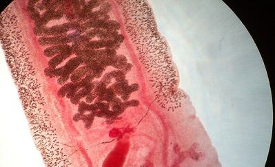 Anquilostomosis en humanos