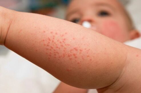 Alergia en un niño como síntoma de la presencia de gusanos.