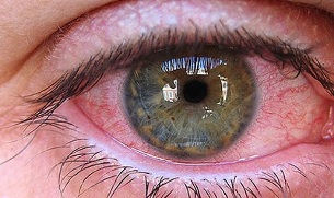 las razones de la aparición de parásitos en los ojos de los humanos